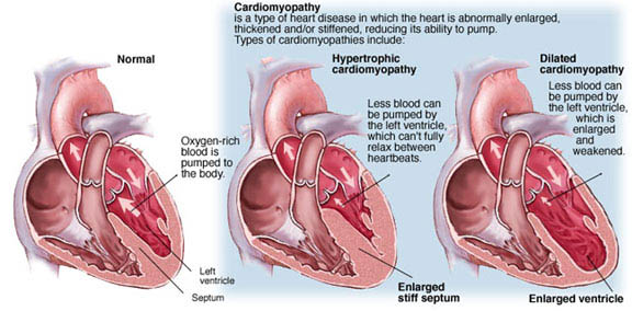 Illustration of cardiomyopathy