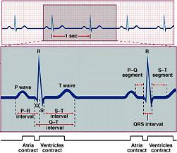 Example of an EKG